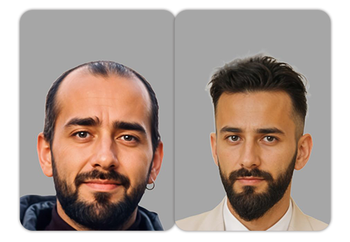 Patient result 1 — before and after hair restoration