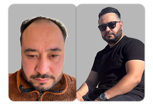 Patient result 2 — before and after hair restoration
