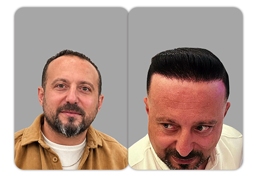 Patient result 3 — before and after hair restoration