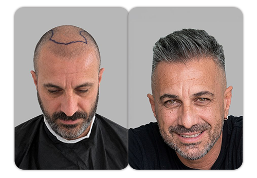 Patient result 5 — before and after hair restoration