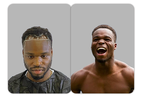 Patient result 6 — before and after hair restoration